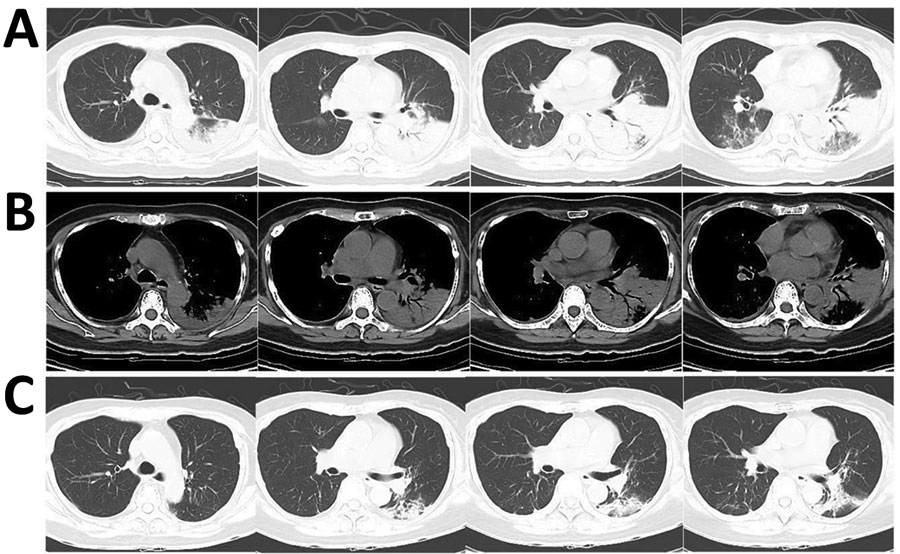 Computed tomography images of the lungs of a a 65-year-old woman with community-acquired pneumonia caused by Legionella pneumophila bacteria, China, showing absorption of infusion in left lobes after effective treatment. Lung window (A) and bone window (B) at the beginning of treatment showed consolidation in the left lobes; after 1 week of treatment (C), infusion is mostly absorbed in the left lobes.