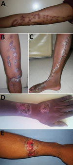 Thumbnail of Clinical manifestations of sporotrichosis in patients with chronic cutaneous and subcutaneous lesions, Madagascar, March 2013–June 2017. A–C) Lymphocutaneous lesions. D) Lymphocutaneous ulcerative budding and crusty lesion. E) Ulceroerosive and erythematosus lesion with irregular border, easily misdiagnosed as chromoblastomycosis.