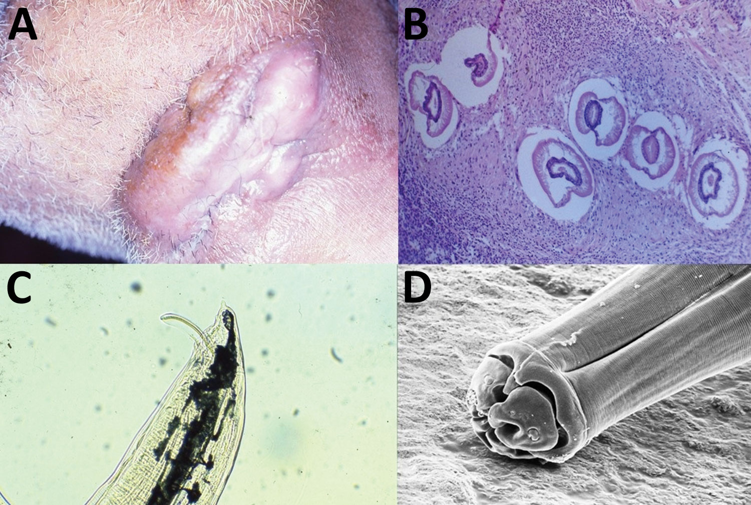 Figure - Nodular Human Lagochilascariasis Lesion in Hunter, Brazil ...