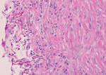 Thumbnail of Soft tissue infection with Diaporthe phaseolorum in a 46-year-old man from Samoa, resident in New Zealand, who was a heart transplant recipient with end-stage renal failure. Histological examination of a cystic lesion over the proximal medial tibia showed reactive fibroblastic proliferation and numerous long-branching fungal septate hyphae of uneven widths. Periodic acid–Schiff staining; original magnification ×40. Photograph provided by Frederica Loghides, Department of Anatomic Pa