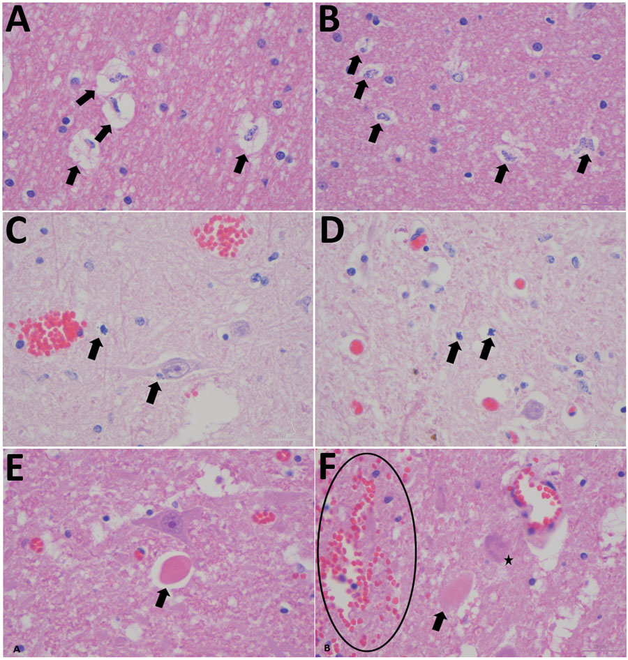 Histopathological changes in formalin-fixed brain tissue of a Shuni virus PCR-positive buffalo (MVA73/10) in South Africa that showed neurologic signs (original magnification 1000×). A, B) Cerebral white matter micro/astrogliosis and cytogenic edema (arrows). C, D) Glial (suspected oligodendroglia) apoptosis (arrows). E, F) Perineural hypereosinophilic bodies (arrows); perivascular and neuropil hemorrhage (circle); single-cell neuronal degeneration (chromatolysis) (star). 