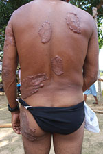 Thumbnail of Multicentric lobomycosis affecting the back, buttocks, and arm of a Kaiabi man, Brazil.