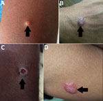 Thumbnail of Types of skin lesions observed in cutaneous leishmaniasis case-patients, Sri Lanka, 2001–2018. Arrows indicate A) papule; B) nodule; C) ulcer; D) plaque.