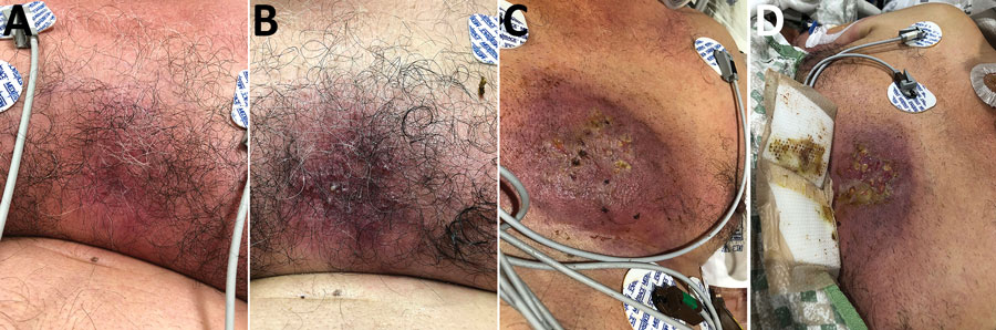 Progressive changes in a cutaneous chest wound for a 63-year-old man who had melioidosis, Texas, USA, 2018. Images were obtained on A) day 3, B) day 4, C) day 9, and D) day 10 after his initial visit to hospital A on November 17, 2018.