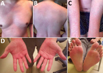 Thumbnail of Whole-body erythema and pruritus in a 42-year-old man infected with Candidatus Mycoplasma haemohominis, Japan. Images show general erythema and pruritus covering &gt;80% of the body surface area. A) Chest, B) back, C) arms, D) hands, E) feet. 
