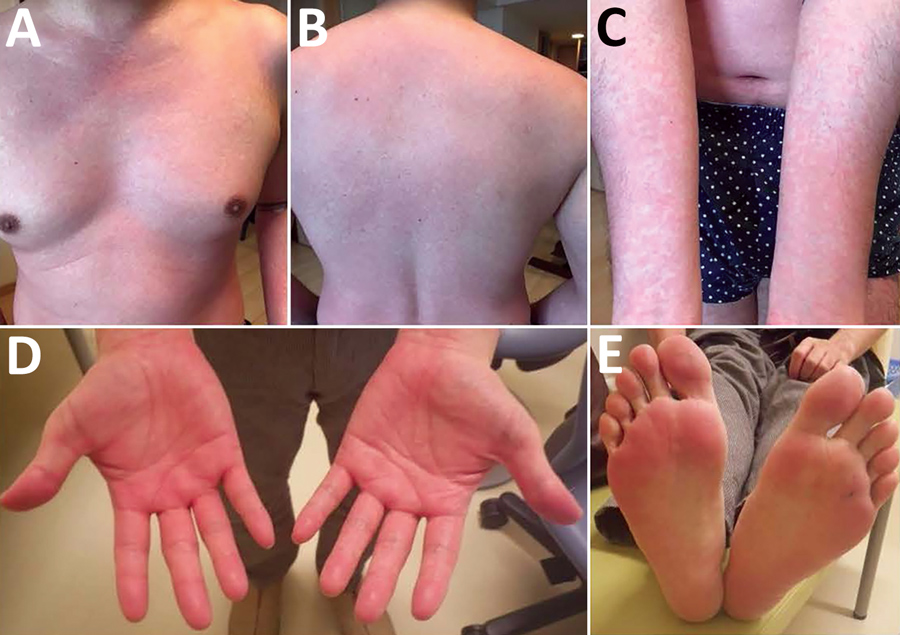 Whole-body erythema and pruritus in a 42-year-old man infected with Candidatus Mycoplasma haemohominis, Japan. Images show general erythema and pruritus covering &gt;80% of the body surface area. A) Chest, B) back, C) arms, D) hands, E) feet. 
