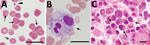 Thumbnail of Distribution of Candidatus Mycoplasma haemohominis in a 42-year-old man, Japan. A) Peripheral blood smear showing coccoid forms. Small basophilic bodies are present on the surface of and outside erythrocytes (arrows). Arrowhead indicates a platelet. Giemsa stained. B) Hemophagocytosis (arrow) in bone marrow aspirate. Giemsa stained. C) Bone marrow biopsy specimen showing infiltration of plasma cells (arrows). Hematoxylin and eosin stained. Scale bars indicate 20 μm.
