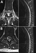 Thumbnail of Neurologic manifestations of tick-borne encephalitis in a 38-year-old man from the United Kingdom after travel to Lithuania. A) Magnetic resonance imaging of the brain and spinal cord at onset of neurologic signs, showing possible longitudinal extensive transverse myelitis in the cervical and thoracic cord, with involvement of the central gray matter. B) One month later, increased T2 signal and mild swelling of the central gray matter of the cervical cord have both regressed, with s