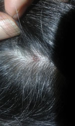 Thumbnail of Scalp eschar of a woman in Austria who was found to be infected with Borrelia afzelii.