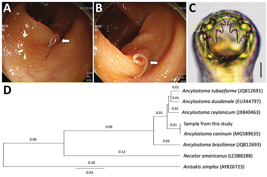 Analysis of a worm from a 60-year-old man in South Korea that was identified as Ancylostoma caninum, the dog hookworm. A, B) Colonoscopy images showing a moving threadlike nematode in the mucosa of the descending colon. This nematode (arrows) is seen hooking its head into the colonic mucosa. C) The head part of the worm, showing its characteristic morphology of 3 pairs of teeth in the buccal cavity, by which it could be morphologically identified as A. caninum. Scale bar indicates 0.1 mm. D) Phy