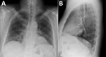 Thumbnail of Chest radiographs displaying bibasilar patchy interstitial opacities in patient with hantavirus pulmonary syndrome, Colorado, USA. A) Posteroanterior view. B) Lateral view. 