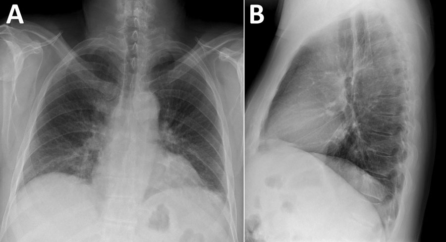 Chest radiographs displaying bibasilar patchy interstitial opacities in patient with hantavirus pulmonary syndrome, Colorado, USA. A) Posteroanterior view. B) Lateral view. 