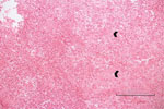 Thumbnail of Bone biopsy specimen for a 3-year-old boy (case 1) with Q fever osteoarticular infection, Israel. Hematoxylin and eosin stain shows an acute inflammatory process with neutrophil and lymphocyte predominance. Small arrows indicate giant cells and epithelioid granuloma without necrosis. Bar indicates the diameter of a giant granuloma. 