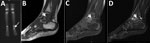 Thumbnail of Imaging of the left ankle for a 2-year-old boy (case 2) with Q fever osteoarticular infection, Israel. A) A nuclear bone scan showing uptake in the talus (arrow). B–D) Magnetic resonance imaging sagittal T1 (B), sagittal T1 fat saturation + contrast (C), and sagittal short-TI inversion recovery (D) showing a lesion (white arrows) in the posterior aspect of the talus, noted to be an intramedullary Brodie's abscess in evolution, surrounded by intramedullary edema and accompanied by fl