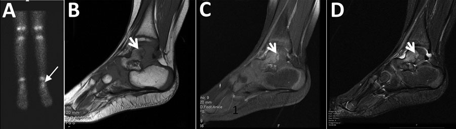 Imaging of the left ankle for a 2-year-old boy (case 2) with Q fever osteoarticular infection, Israel. A) A nuclear bone scan showing uptake in the talus (arrow). B–D) Magnetic resonance imaging sagittal T1 (B), sagittal T1 fat saturation + contrast (C), and sagittal short-TI inversion recovery (D) showing a lesion (white arrows) in the posterior aspect of the talus, noted to be an intramedullary Brodie's abscess in evolution, surrounded by intramedullary edema and accompanied by fluid in the jo