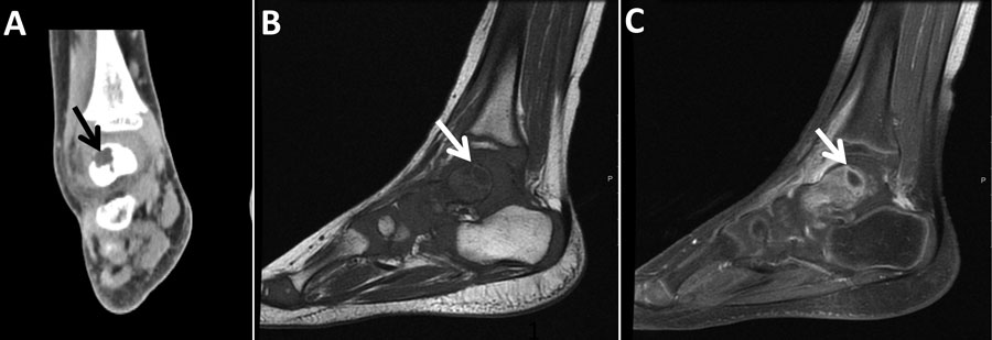 Imaging of the left ankle for a 3-year-old boy (case 3) with Q fever osteoarticular infection, Israel. A) Computed tomography imaging, coronal view, shows a lytic lesion in the talus (black arrow). B, C) Magnetic resonance imaging sagittal T1 (B) and sagittal T1 fat saturation + contrast (C) demonstrate a lesion in the posterior aspect of the talus (white arrows), determined to be an intramedullary abscess (Brodie’s abscess) surrounded by edema.