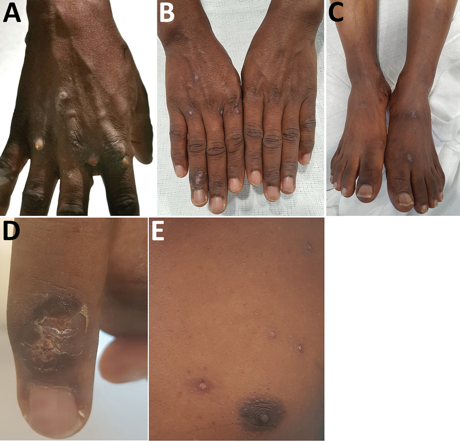 Dermatologic features of monkeypox in a 38-year-old man, Singapore, 2019. A) Pustular lesions on the hand at the start of hospitalization. B, C) Resolving lesions with shedding of scabs of the hands (B) and feet (C) toward end of hospitalization (day 17). D, E) Crusting of right fourth finger lesion (D) and lesions at varying stages (vesicles and scabbing) on the left chest (E) on day 15 of hospitalization.
