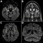 Thumbnail of Cerebral magnetic resonance imaging scans compatible with the diagnosis of encephalitis in a 58-year-old woman, France. Fluid-attenuated inversion recovery (FLAIR) and T2 hypersignals in limbic system structures, including both amygdalae (A, arrows), temporal poles (B, arrows), and insular cortex (C), associated with FLAIR hyperintensities of the cerebellar cortex (D).