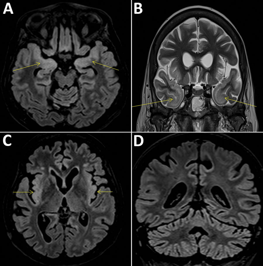Cerebral magnetic resonance imaging scans compatible with the diagnosis of encephalitis in a 58-year-old woman, France. Fluid-attenuated inversion recovery (FLAIR) and T2 hypersignals in limbic system structures, including both amygdalae (A, arrows), temporal poles (B, arrows), and insular cortex (C), associated with FLAIR hyperintensities of the cerebellar cortex (D).