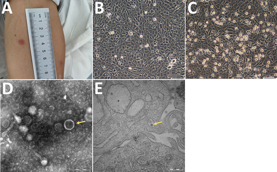 Clinical and morphological features of Tacheng tick virus 2 in a patient, China. A) Erythema at the site of tick bite on the anterior surface of the patient’s left arm. B) Human hepatocellular carcinoma (SMMC-7721) cells without TcTV-2 infection; magnification × 100. Scale bar indicates 50 μm. C) TcTV-2–infected SMMC-7721 cells showing cytopathic effects visible by light microscopy; magnification × 100. Scale bar indicates 50 μm. D) Negatively stained virions purified from TcTV-2–infected SMMC-7721 cells (arrows); magnification × 25,000. Scale bar indicates 200 nm. E) Transmission electron microscopy image of TcTV-2–infected SMMC-7721 cells (arrows); magnification × 50,000. Scale bar indicates 500 nm. TcTV-2, Tacheng tick virus 2.