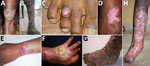Thumbnail of Clinical forms of chromoblastomycosis caused by Fonsecaea sp., Madagascar. A) Plaque; B) mixed: tumorous and cicatricial; C) nodular; D) raised plaque; E) plaque; F) cicatricial; G) tumorous caused by Cladophialophora carrionii; H) mixed: cicatricial and modified by previous therapy.
