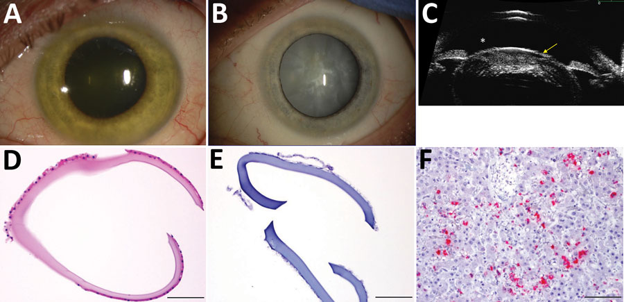 Cataract surgery in an Ebola virus disease survivor with prior ocular viral persistence. A) Slit lamp image shows green iris hue when patient developed panuveitis with heterochromia. B) The greenish coloration resolved but a dense intumescent cataract developed as shown in the second slit lamp image. C) Ultrasound biomicroscopic examination demonstrates the bulging of the anterior lens capsule (yellow arrow) and shallowing of the anterior chamber (*), which presents an increased risk for anterio