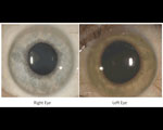 Thumbnail of Cataract surgery in an Ebola virus disease survivor with prior ocular viral persistence.