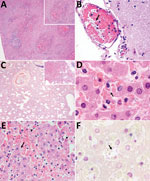 Microscopic findings of histological and histochemical examination of tissue samples from captive marmosets in investigation of a fatal epizootic caused by highly virulent Klebsiella pneumoniae sequence type 86 strain P04 in Brazil, 2019. A) Spleen shows necrosis in germinal centers, suppurative splenitis, and hemorrhage (inset: necrosis in germinal center). Hematoxylin and eosin stain (H&E); original magnification ×4. B) Brain (meninges) shows bacterial rods inside vascular lumen (arrow). H&E stain; original magnification ×40. C) Lung shows sinterstitial pneumonia (H&E stain; original magnification ×4) and alveolar hemorrhage (inset; H&E stain; original magnification ×10). D–F) Liver samples. D) Numerous intravascular bacilli (arrow). H&E stain; original magnification ×100. E) Hepatocellular necrosis (arrowheads) associated with numerous bacterial rods (arrow) and neutrophils in the sinusoids. H&E stain; original magnification ×40. F) Sinusoids filled with gram-negative bacterial structures (arrow) and neutrophils. Gram stain; original magnification ×1,000.