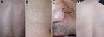 Thumbnail of Lesions on the skin of a patient infected with Oxyspirura larvae, Vietnam. A, B) Lesions on the back and abdomen. C) Lesions on the face, with visible larvae. D) Lesions on the patient’s back 2 months after treatment.