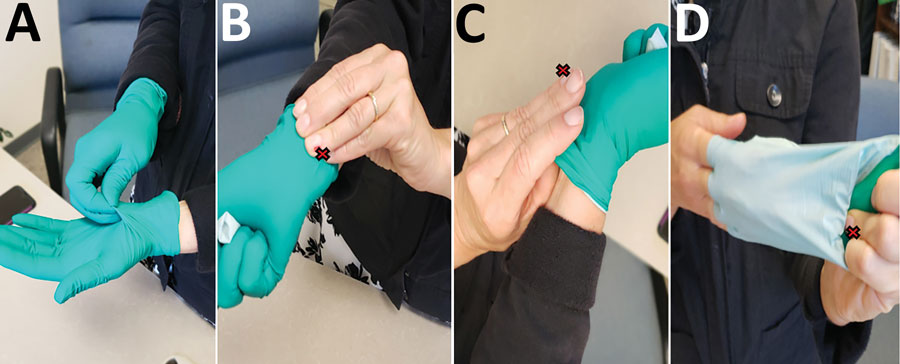 Depiction of improper protocol for doffing gloves the case-patient reported using while conducting a protocol for growth and purification of high-titer dengue virus, United States, 2018. The red X indicates the location of an open wound on the ring finger of the case-patient’s left hand.