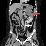 Thumbnail of Coronal contrast enhanced CT (computed tomography) of the abdomen of a child with disseminated Echinococcus multilocularis infection without liver involvement, Canada, 2018. There is a large irregular hypodense left renal lesion (red arrow). A large porto-systemic shunt is partially visualized (white arrow).