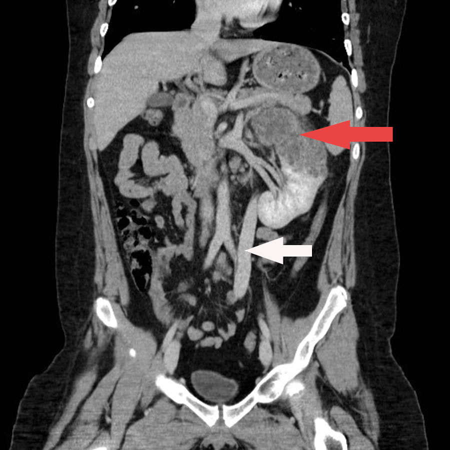 Coronal contrast enhanced CT (computed tomography) of the abdomen of a child with disseminated Echinococcus multilocularis infection without liver involvement, Canada, 2018. There is a large irregular hypodense left renal lesion (red arrow). A large porto-systemic shunt is partially visualized (white arrow).