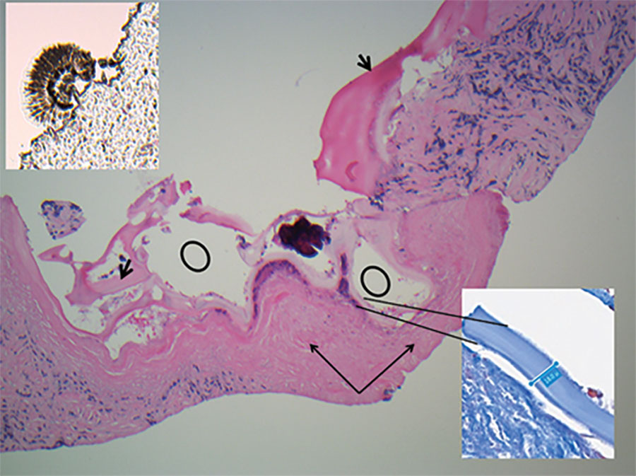 Kidney core biopsy of a child with disseminated Echinococcus multilocularis infection without liver involvement, Canada, 2018. Shown are folded laminated membrane (short black arrows) encircling variable-sized cystic structures (black circles) containing calcified and necrotic debris and dense periparasitic fibrosis (long black arrows), in a background of chronic inflammation and fibrosis. No residual normal kidney parenchyma was seen (hematoxylin and eosin stain, original magnification × 40). I