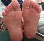 Unilateral, painless, maculopapular, erythematous rash over the sole of the left foot of an immunocompromised patient in Israel with suspected Janeway lesions who had endovascular infection with Kingella kingae complicated by septic arthritis. The rash disappeared a few days after initiation of antimicrobial drug treatment.