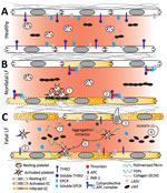 Working model of endothelial barrier function during time-of-admission for Lassa fever showing differences in function between healthy endothelium, and endothelium in nonfatal and fatal Lassa fever, Sierra Leone during 2015–2018. A) Healthy endothelium; resting platelets circulate and lower molecular weight vWF multimers are constitutively secreted by the endothelium. B) Endothelium barrier function in non-fatal Lassa fever. 1) Immune mediated damage near infected endothelial cells leads to collagen exposure, fibrin deposition, platelet activation, endothelial activation, and release of ultra-high molecular weight vWF from endothelial cells and platelets. Functional coagulation and platelet responses lead to endothelial repair. 2) Endothelial surface bound thrombomodulin and EPCR lead to activation of protein C; PAR-1 activation strengthens endothelial tight junctions, increases endothelial survival, and dampens the inflammatory response. C) Endothelium barrier function in fatal Lassa fever. 3) Increased endothelial infection has been observed in fatal LF cases. Increased immune infiltrates likely stress the endothelial barrier and lead to increased endothelial activation, evidenced by increased soluble ICAM, P-selectin, and EPCR. 4) Ultra-high molecular weight vWF multimers are broken down by ADAMTS-13, likely leading to the increased vWF ELISA signal observed during fatal LF. 5) Increases in soluble thrombomodulin and EPCR likely leave less surface bound forms, inhibiting the ability of endothelial cells to activate cytoprotective pathways through PAR-1 and increasing their susceptibility to immune mediated destruction. 6) Our in vitro aggregation studies show that platelets in the presence of the aggregation inhibitor become activated and change shape in response to platelet agonists but fail to maintain the aggregated state. These data are consistent with the inhibition of the release of α or dense granules or their contents, thereby inhibiting certain aspects of primary hemostasis, clot formation, and endothelial repair. 7) The state of fibrinolysis during fatal LF is unclear. Increased PAI-1 suggests an inhibition of fibrinolysis, but D-dimers and other FDPs are only formed during plasmin mediated breakdown of fibrin. Likely, increased platelet activation leads to an increase of total fibrin formation. Platelet dysfunction can lead to weaker hemostatic plugs which then leave fibrin more susceptible to cleavage by plasmin. APC, activated protein C; EC, endothelial cell; EPCR, endothelial protein C receptor; FDP, fibrin degradation product; ICAM, intercellular adhesion molecule; LASV, Lassa fever virus; PAI-1, plasminogen activator inhibitor 1; PAR-1, protease-activated receptor 1; plasminogen activator inhibitor 1; THBD, thrombomodulin; vWF, von Willebrand factor.