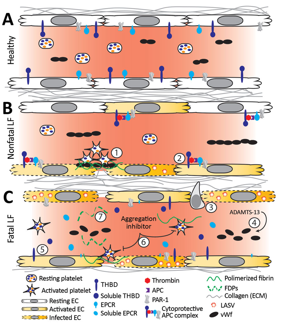 Working model of endothelial barrier function during time-of-admission for Lassa fever showing differences in function between healthy endothelium, and endothelium in nonfatal and fatal Lassa fever, Sierra Leone during 2015–2018. A) Healthy endothelium; resting platelets circulate and lower molecular weight vWF multimers are constitutively secreted by the endothelium. B) Endothelium barrier function in non-fatal Lassa fever. 1) Immune mediated damage near infected endothelial cells leads to collagen exposure, fibrin deposition, platelet activation, endothelial activation, and release of ultra-high molecular weight vWF from endothelial cells and platelets. Functional coagulation and platelet responses lead to endothelial repair. 2) Endothelial surface bound thrombomodulin and EPCR lead to activation of protein C; PAR-1 activation strengthens endothelial tight junctions, increases endothelial survival, and dampens the inflammatory response. C) Endothelium barrier function in fatal Lassa fever. 3) Increased endothelial infection has been observed in fatal LF cases. Increased immune infiltrates likely stress the endothelial barrier and lead to increased endothelial activation, evidenced by increased soluble ICAM, P-selectin, and EPCR. 4) Ultra-high molecular weight vWF multimers are broken down by ADAMTS-13, likely leading to the increased vWF ELISA signal observed during fatal LF. 5) Increases in soluble thrombomodulin and EPCR likely leave less surface bound forms, inhibiting the ability of endothelial cells to activate cytoprotective pathways through PAR-1 and increasing their susceptibility to immune mediated destruction. 6) Our in vitro aggregation studies show that platelets in the presence of the aggregation inhibitor become activated and change shape in response to platelet agonists but fail to maintain the aggregated state. These data are consistent with the inhibition of the release of α or dense granules or their contents, thereby inhibiting certain aspects of primary hemostasis, clot formation, and endothelial repair. 7) The state of fibrinolysis during fatal LF is unclear. Increased PAI-1 suggests an inhibition of fibrinolysis, but D-dimers and other FDPs are only formed during plasmin mediated breakdown of fibrin. Likely, increased platelet activation leads to an increase of total fibrin formation. Platelet dysfunction can lead to weaker hemostatic plugs which then leave fibrin more susceptible to cleavage by plasmin. APC, activated protein C; EC, endothelial cell; EPCR, endothelial protein C receptor; FDP, fibrin degradation product; ICAM, intercellular adhesion molecule; LASV, Lassa fever virus; PAI-1, plasminogen activator inhibitor 1; PAR-1, protease-activated receptor 1; plasminogen activator inhibitor 1; THBD, thrombomodulin; vWF, von Willebrand factor.