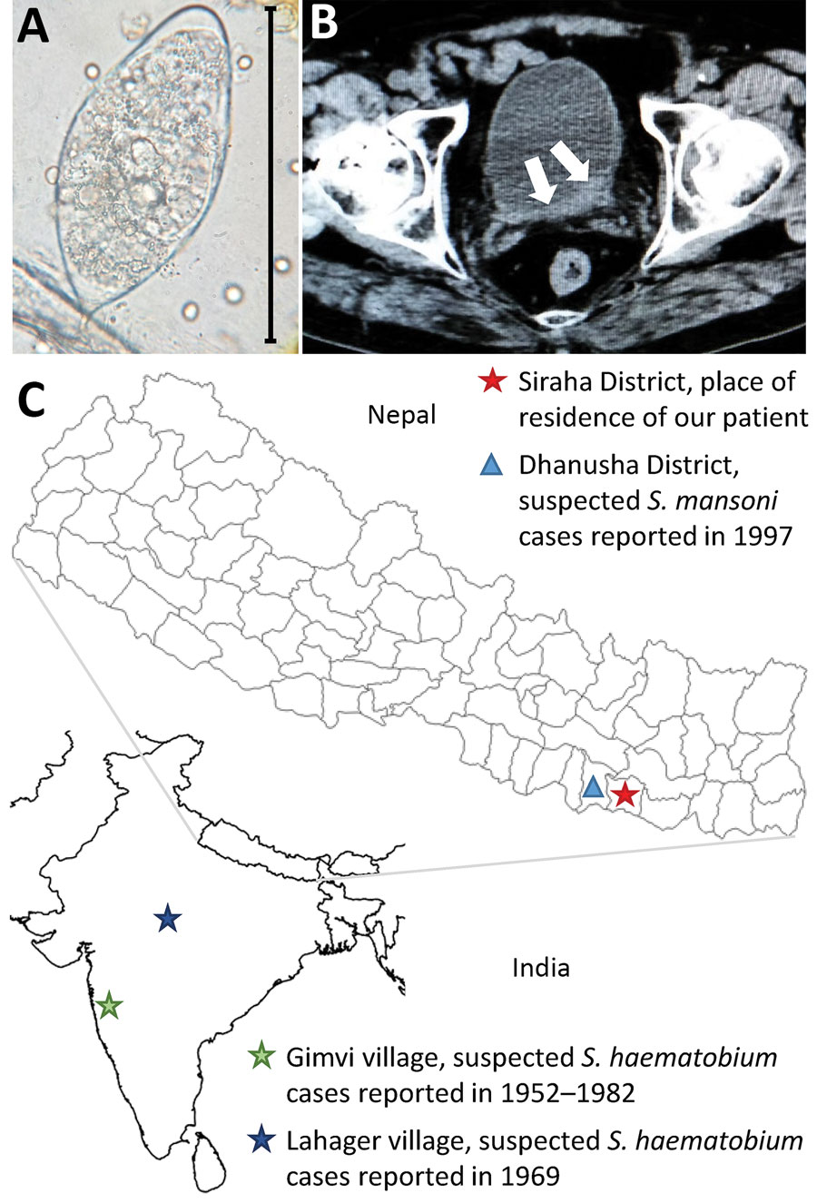Investigation of urogenital schistosomiasis in a 34-year-old male patient in Nepal. A) Trematode egg, resembling the typical Schistosoma haematobium morphology, detected upon microscopic investigation of patient’s urine sediment. Original magnification ×40. B) Computed tomography image showing bladder wall thickening (white arrows). C) Geographic location of patient’s place of residence and of cases of human schistosomiasis reported previously in India and Nepal.