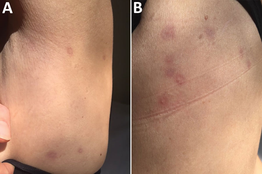Roundish, targetoid patches, with peripheral erythematous halo and central lightening located on left abdomen (A) and on the back (B) of a 48-year-old woman with trombiculosis, Italy, April 2019.