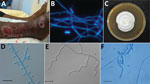 Thumbnail of Features of Nannizziopsis obscura infections in patients from West Africa, France 2004–2020. A) Ulcerative lesions. B) Septate hyphae and arthroconidia on a calcofluor white direct examination (original magnification ×200). C) Macroscopic aspect on Sabouraud dextrose agar at 7 days. D) Septate conidiophore bearing clavate and sessile conidia. E) Undulate hyphae. F) Barrel-shaped arthroconidia. Scale bars indicate 10 µm.