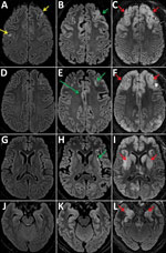 Thumbnail of Fluid-attenuated inversion recovery images of magnetic resonance examinations of the brain in a 28-year-old woman from Romania with untreated AIDS and measles inclusion-body encephalitis. Images were taken 1 week (A, D, G, J), 2 weeks (B, E, H, K), and 5 weeks (C, F, I, L) after hospital admission, at the same brain levels. The first examination shows focal cortical hyperintensities (yellow arrows) in the left and right frontal cortex. After 2 weeks, these cortical hyperintensities 