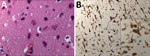 Thumbnail of Histology and immunohistochemical staining of the cerebral cortex in a 28-year-old woman from Romania with untreated AIDS and measles inclusion-body encephalitis. A) Histology shows moderate increased cellular density and absence of nuclear inclusion bodies. Hematoxylin and eosin stain; original magnification ×100. B) Immunohistochemical staining microglial activation with high CD163 immunoreactivity Anti-human CD163 monoclonal antibody; original magnification ×100 and (inset) ×400.