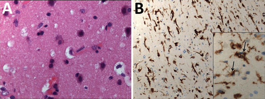 Histology and immunohistochemical staining of the cerebral cortex in a 28-year-old woman from Romania with untreated AIDS and measles inclusion-body encephalitis. A) Histology shows moderate increased cellular density and absence of nuclear inclusion bodies. Hematoxylin and eosin stain; original magnification ×100. B) Immunohistochemical staining microglial activation with high CD163 immunoreactivity Anti-human CD163 monoclonal antibody; original magnification ×100 and (inset) ×400.