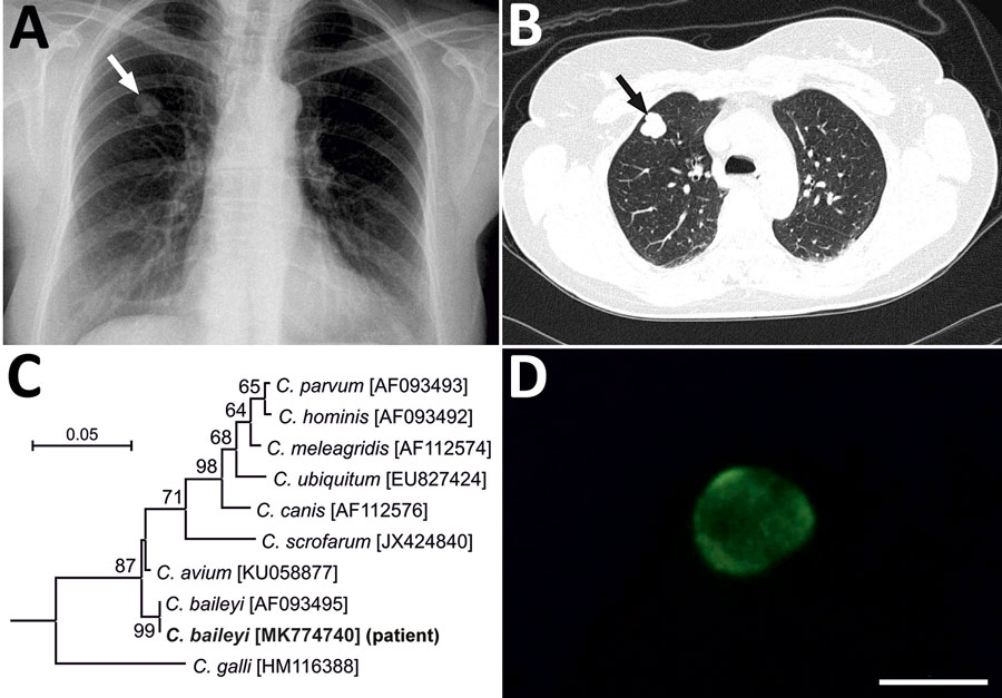 crypto lung infection