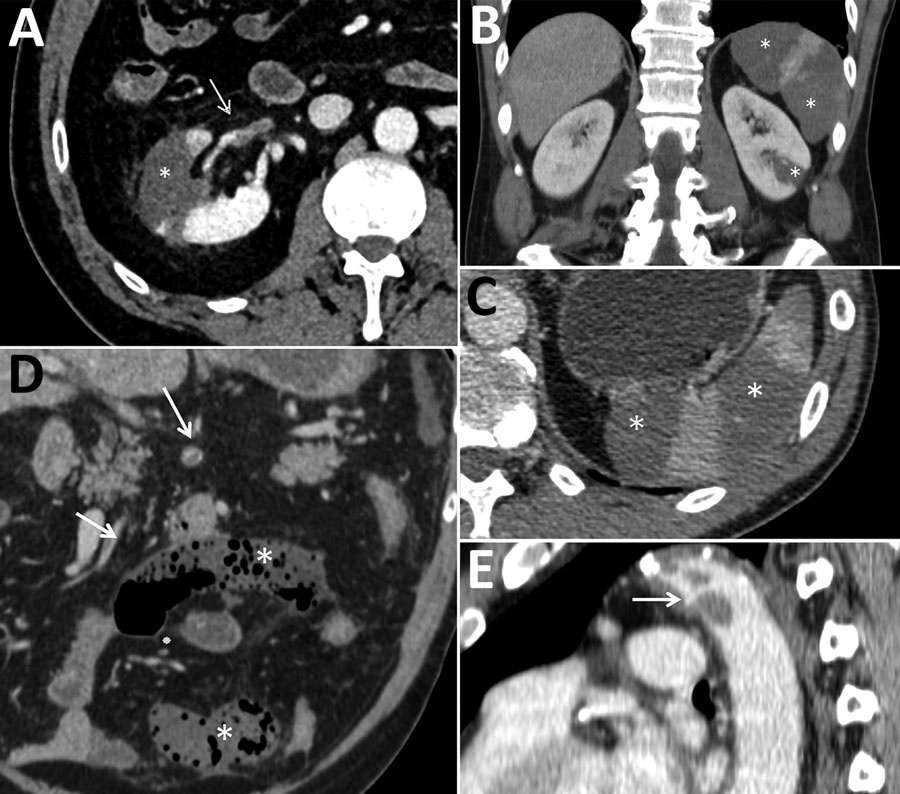 Abdominal contrast-enhanced computed tomography scans of 3 coronavirus disease patients with abdominal visceral infarction, Italy. A) Patient 1 (axial view) showing intraarterial thrombi in the renal artery (arrow) and kidney and splenic infarctions (asterisk), seen as large wedge-shaped hypodense parenchymal areas. B, C) Patient 2 (B, coronal view; C, axial view) showing kidney and splenic infarctions (asterisks), seen as large wedge-shaped hypodense parenchymal areas. D, E) Patient 3 (D, coron
