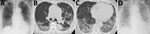 Thumbnail of Chest radiograph and computed tomography results from an 84-year-old woman who died from coronavirus disease, Toshima Hospital, Tokyo, Japan, February 2020. A) Chest radiographs taken on admission (illness day 8), showing reticular shadows, mainly in bilateral lower lung fields. B, C) Chest computed tomography scan taken on illness day 8, indicating ground-glass opacities mainly located in posterior segments of the bilateral lower lobes, where the highest numbers of viral RNA copies