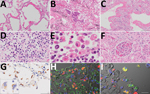 Thumbnail of Pathologic findings for the lungs, lymph nodes, and kidneys in an autopsy of an 84-year-old woman who died from coronavirus disease, Toshima Hospital, Tokyo, Japan, February 2020. A) Marked diffuse alveolar damage in exudative phase with prominent hyaline membrane formation in lung tissues. Hematoxylin &amp; eosin (H&amp;E) staining. Scale bar indicates 200 µm. B, C) Desquamation and squamous metaplasia of the epithelium (B) and organized hyaline membranes (C), with septal fibrosis 