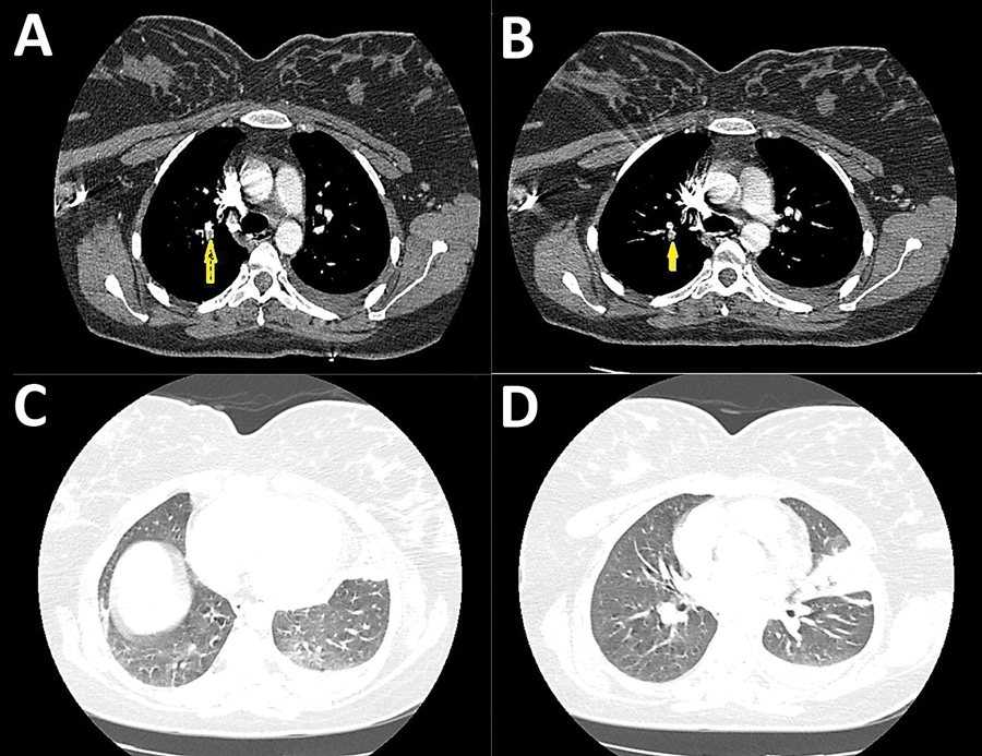 Thoracic computed tomography angiography of a 36-year-old postpartum woman with coronavirus disease and acute pulmonary embolism, Iran. A, B), Thoracic computed tomography angiography showing filling defect in the right side inter-lobar artery (arrow) and posterior basal segment and left-sided pleural effusion (arrow). C, D) Consolidation and ground-glass opacities affecting the left ligula and posterior recess.