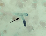 Thumbnail of Microscopic image of silver-stained tracheal aspirate from an immunocompetent patient critically ill with coronavirus disease, France. Filaments suggestive of Aspergillus sp. are shown (black arrow). Original magnification ×1,000.