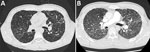 Thumbnail of Computed tomography (CT) scans of a coronavirus disease (COVID-19) patient with sarcoidosis who had been receiving long-term hydroxychloroquine treatment, France. A) Thoracic CT scan from November 2019, showing baseline pulmonary sarcoidosis lesions. B) Thoracic CT scan performed April 4, 2020, showing diffuse ground-glass opacities characteristic of COVID-19.