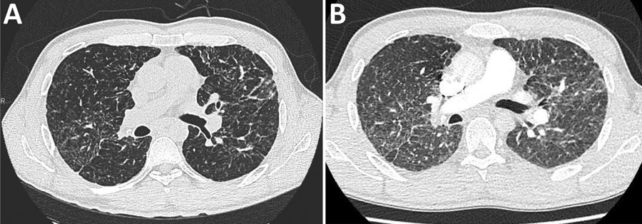 Computed tomography (CT) scans of a coronavirus disease (COVID-19) patient with sarcoidosis who had been receiving long-term hydroxychloroquine treatment, France. A) Thoracic CT scan from November 2019, showing baseline pulmonary sarcoidosis lesions. B) Thoracic CT scan performed April 4, 2020, showing diffuse ground-glass opacities characteristic of COVID-19.